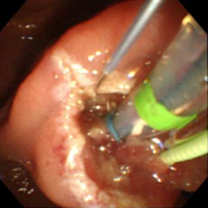 ercp2.jpg